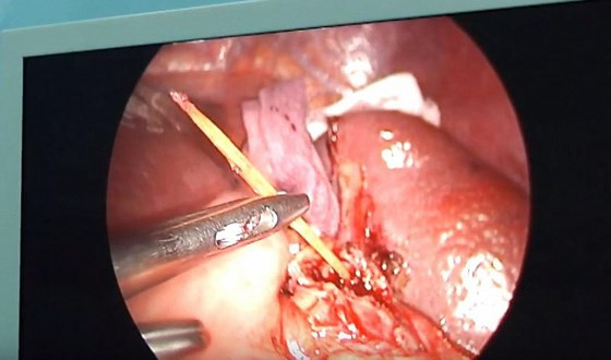 Dị vật là tăm tre nhọn được phát hiện trong ổ bụng của một bệnh nhân Dị vật là tăm tre nhọn được phát hiện trong ổ bụng của một bệnh nhân