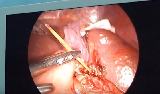  Dị vật là tăm tre nhọn được phát hiện trong ổ bụng của một bệnh nhân