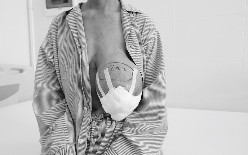 Nữ bệnh nhân hối hận vì vì chỉ đắp lá thuốc khiến khối u trên ngực nặng tới 4kg. (Ảnh do BV cung cấp)