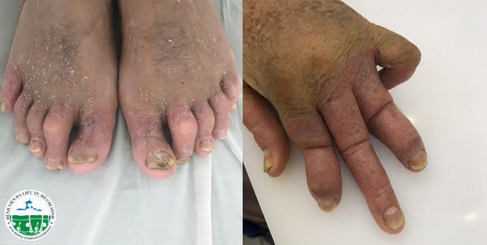 Vảy nến khớp có thể gây biến dạng, phá hủy khớp không hồi phục, khiến bệnh nhân bị tàn phế, ảnh hưởng nghiêm trọng tới chất lượng cuộc sống và sức khỏe người bệnh Vảy nến khớp có thể gây biến dạng, phá hủy khớp không hồi phục, khiến bệnh nhân bị tàn phế, ảnh hưởng nghiêm trọng tới chất lượng cuộc sống và sức khỏe người bệnh