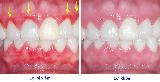 Dấu hiệu bị viêm lợi. Dấu hiệu bị viêm lợi.