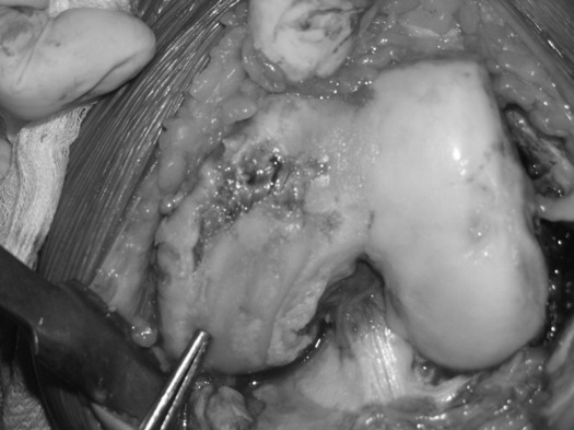 Hư hại hoàn toàn sụn khớp trong thoái hoá khớp là nguồn gốc cơn đau khớp gối khi đi và gây ra tiếng kêu lạo xạo khi cử động - Ảnh: TS. Tăng Hà Nam Anh