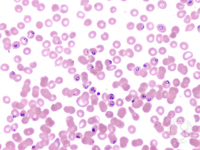  Plasmodium falciparum, 