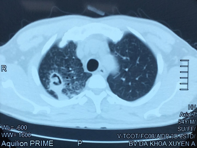 Nấm phổi là căn bệnh có thể gây tử vong cao - ẢNH: BVCC