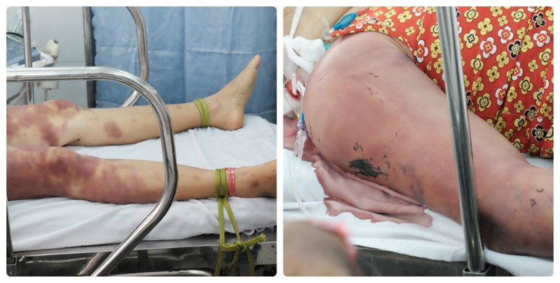 Vết thương bầm tím phủ khắp cơ thể bà T. khi bị 