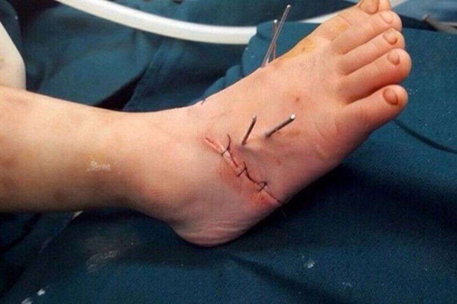 Chân bệnh nhi được nối thành công. Chân bệnh nhi được nối thành công.