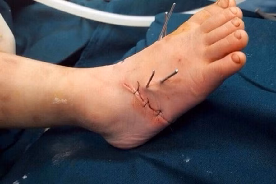 Chân bệnh nhi được nối thành công. Chân bệnh nhi được nối thành công.