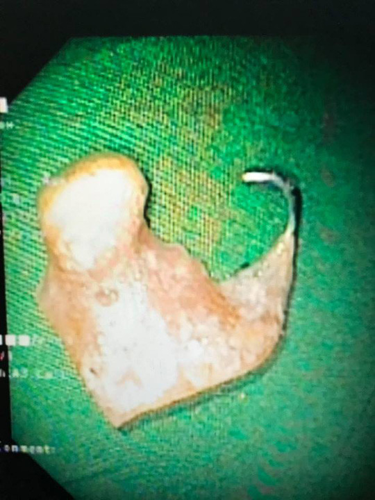 Chiếc móc câu sắc nhọn 