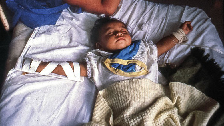 Một cháu bé 3 tuổi mắc bệnh tả trong đợt dịch ở Peru năm 1991 - Ảnh: AP Một cháu bé 3 tuổi mắc bệnh tả trong đợt dịch ở Peru năm 1991 - Ảnh: AP