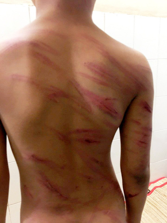 Vết thương khắp cơ thể em P. do bị cha dượng bạo hành. Ảnh do nhân vật cung cấp. Vết thương khắp cơ thể em P. do bị cha dượng bạo hành. Ảnh do nhân vật cung cấp.