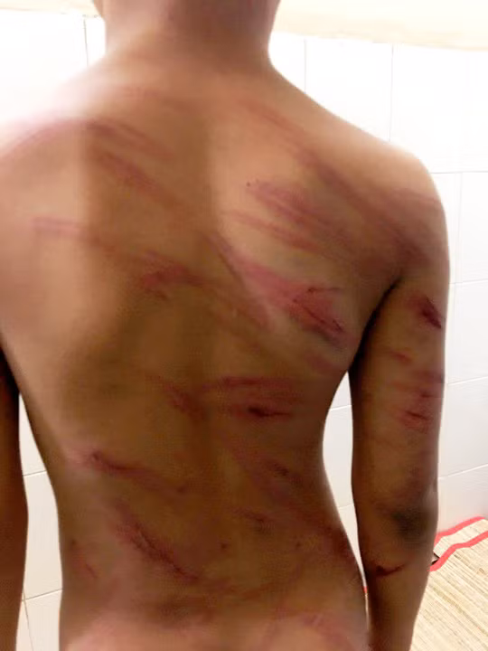 Vết thương khắp cơ thể em P. do bị cha dượng bạo hành. Ảnh do nhân vật cung cấp.