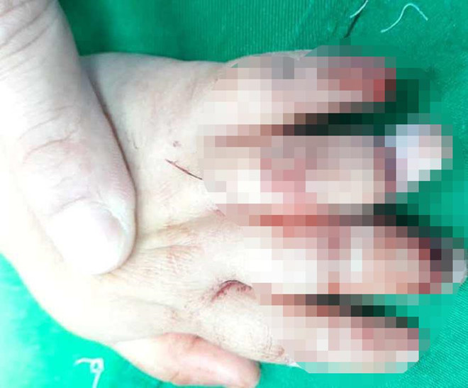  Cháu bé bị dập nát bàn tay trái do máy xay thịt cuốn vào. Ảnh: Bệnh viện cung cấp.