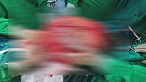  Khối u to lấy ra khỏi cơ thể bà cụ.