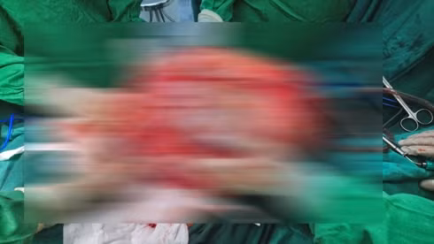  Khối u to lấy ra khỏi cơ thể bà cụ.