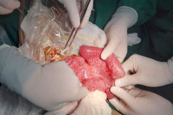 Bác sĩ mổ gắp giun cho bệnh nhi