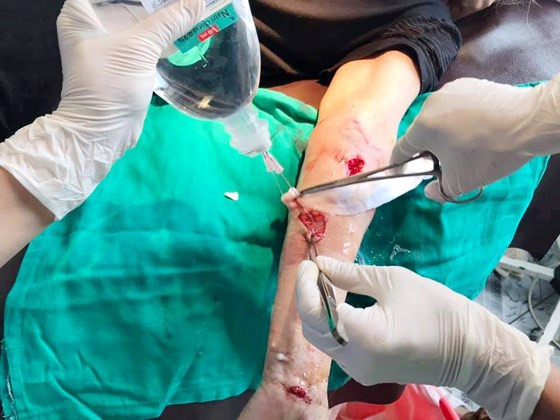  Các vết thương trên phần tay của bệnh nhân