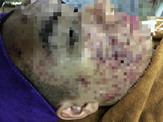 Da mặt người phụ nữ bị cày nát sau lăn kim