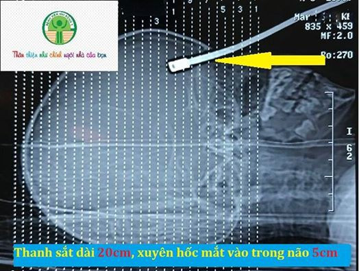 Thanh sắt dài 20 cm, xuyên hốc mắt vào não 5 cm