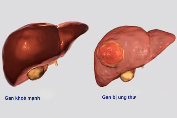  Hình ảnh so sánh giữa lá gan khoẻ mạnh và gan bị ung thư