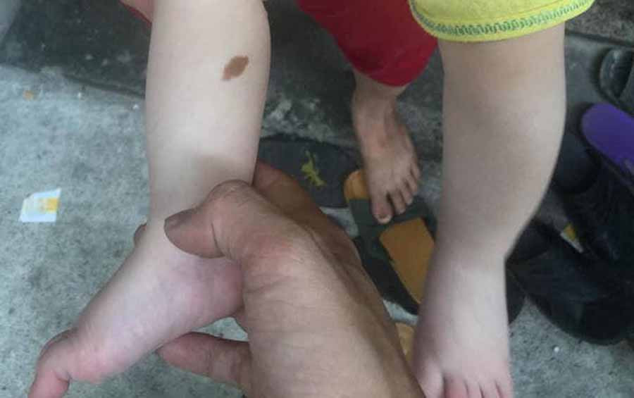 Cháu bé có bớt đen ở chân. Cháu bé có bớt đen ở chân.