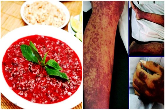 Ăn tiết canh heo là nguyên nhân chính gây nhiễm khuẩn liên cầu trên người