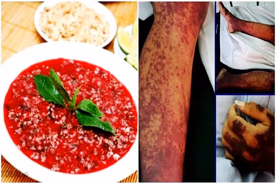 Ăn tiết canh heo là nguyên nhân chính gây nhiễm khuẩn liên cầu trên người