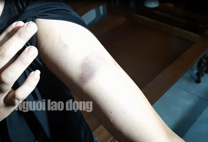 Những vết bầm tím khắp cơ thể em Q.