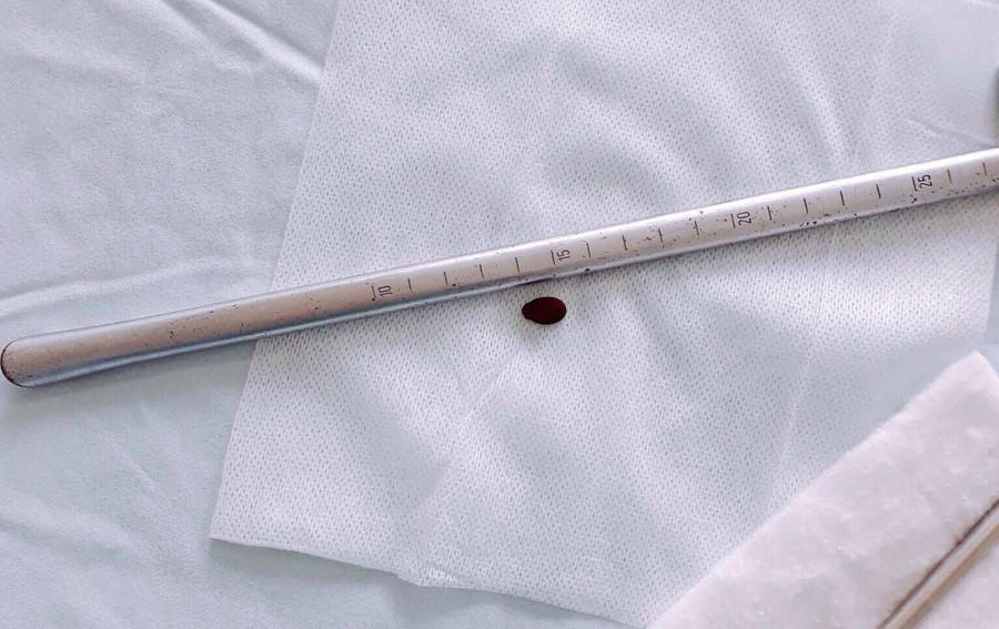 Hạt dưa được gắp ra khỏi phế quản của A Băng. Ảnh: Văn Ngọc 