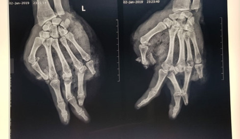  Hình ảnh phim chụp X-quang cho thấy bàn tay của bị bệnh nhân bị chấn thương (Ảnh: Bệnh viện cung cấp)