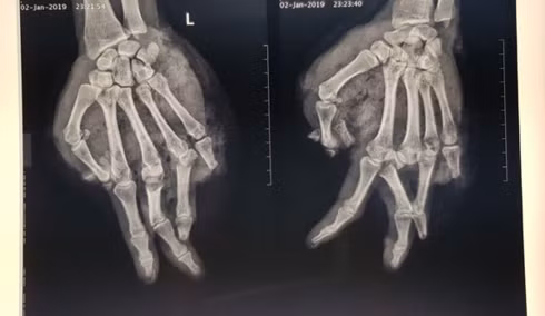  Hình ảnh phim chụp X-quang cho thấy bàn tay của bị bệnh nhân bị chấn thương (Ảnh: Bệnh viện cung cấp)