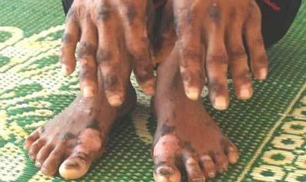 "Bệnh lạ" ở Quảng Ngãi khiến dư luận hoang mang trước khi tìm được căn nguyên gây bệnh - Ảnh: Thái Thuỵ "Bệnh lạ" ở Quảng Ngãi khiến dư luận hoang mang trước khi tìm được căn nguyên gây bệnh - Ảnh: Thái Thuỵ