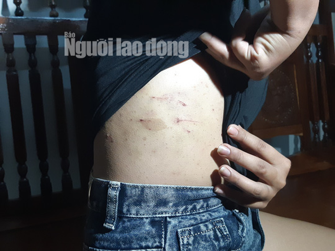  Đối tượng Thái đã dùng dao, chìa khóa, tuốc nơ vít chọc vào khắp cơ thể em Q.