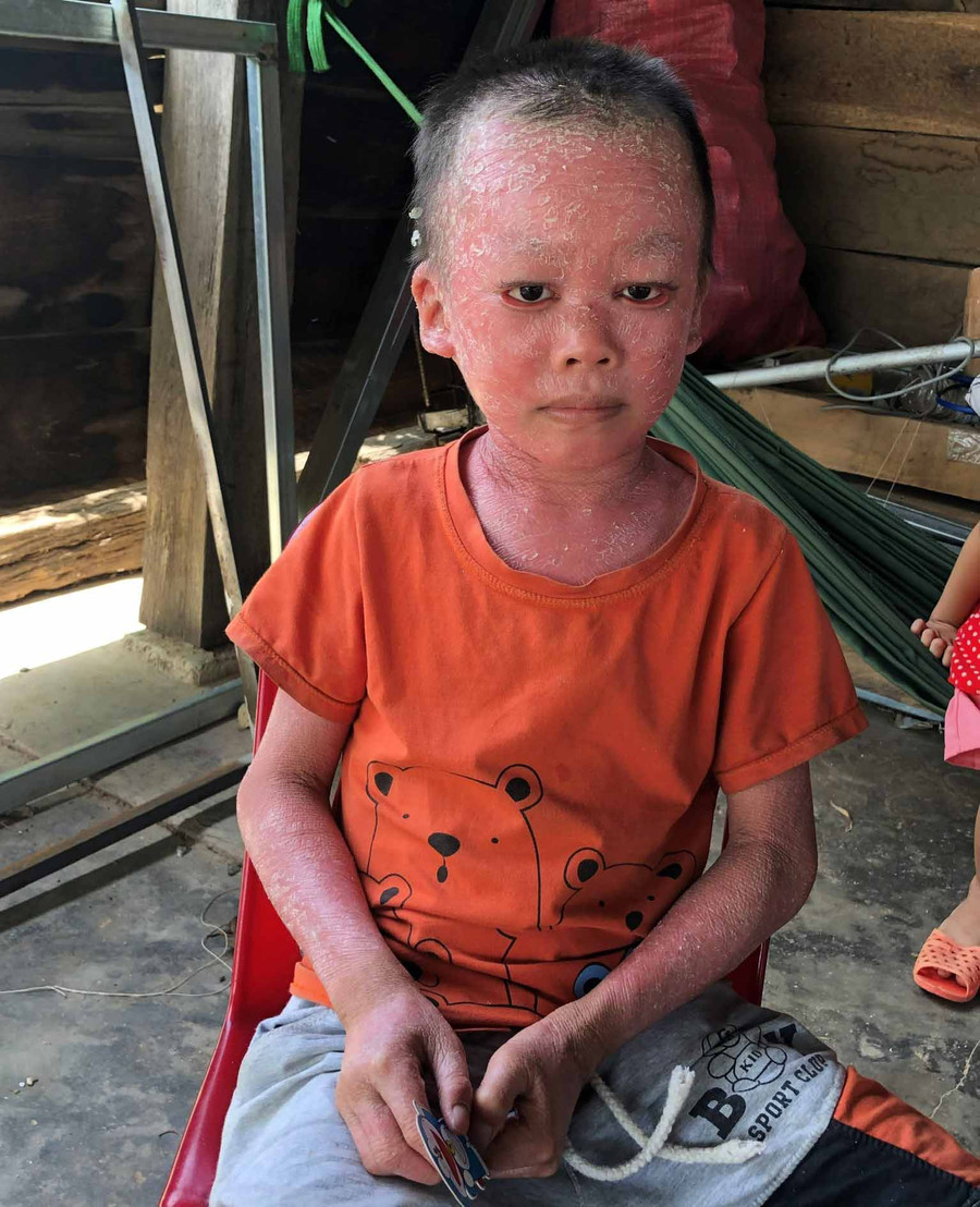 Suốt 9 năm qua, cháu Lê Bảo Duy luôn bị đau đớn bởi căn bệnh lạ. Ảnh: Anh Huy