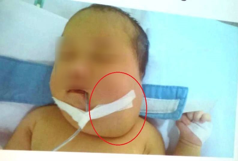 Bé gái 20 ngày tuổi mắc khối bướu quái Bé gái 20 ngày tuổi mắc khối bướu quái