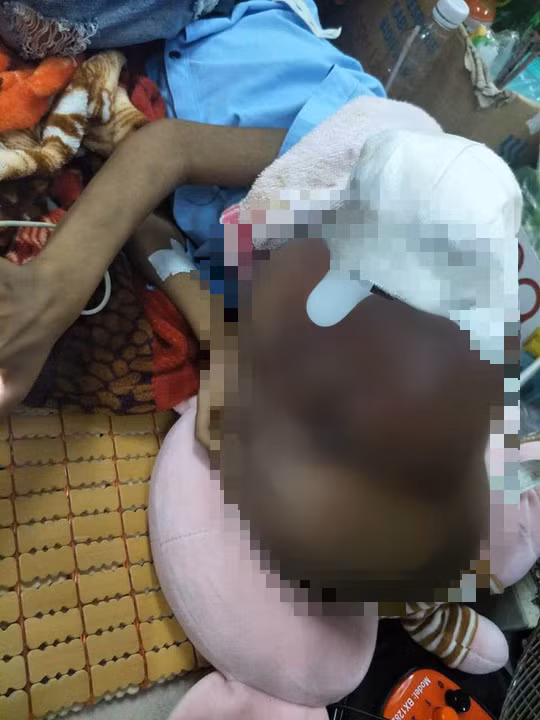  Bé T. oằn mình với khối u khổng lồ trên mặt