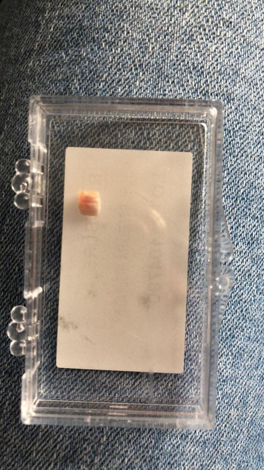  Chiếc răng bé nhỏ của Isla-Rose - ảnh do gia đình cung cấp