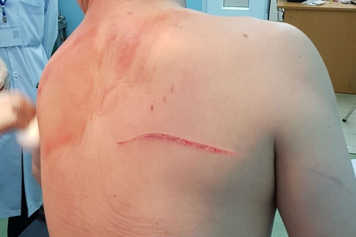 Bác sĩ Chiêm Quốc Thái cho rằng ông may mắn thoát chết, thương tích chỉ 5%.