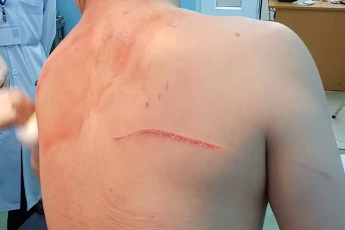 Bác sĩ Chiêm Quốc Thái cho rằng ông may mắn thoát chết, thương tích chỉ 5%.