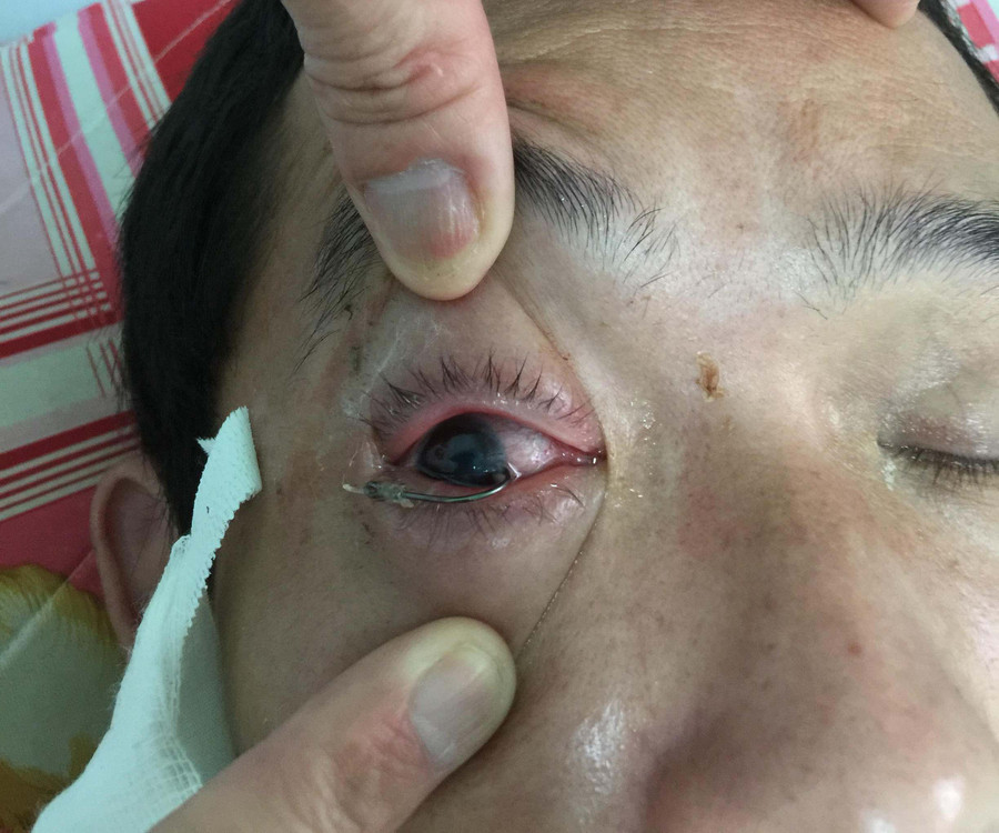  Bác sĩ bệnh viện Quân y 211 phẫu thuật thành công trường hợp lưỡi câu móc vào mắt. Ảnh: Chí Hào