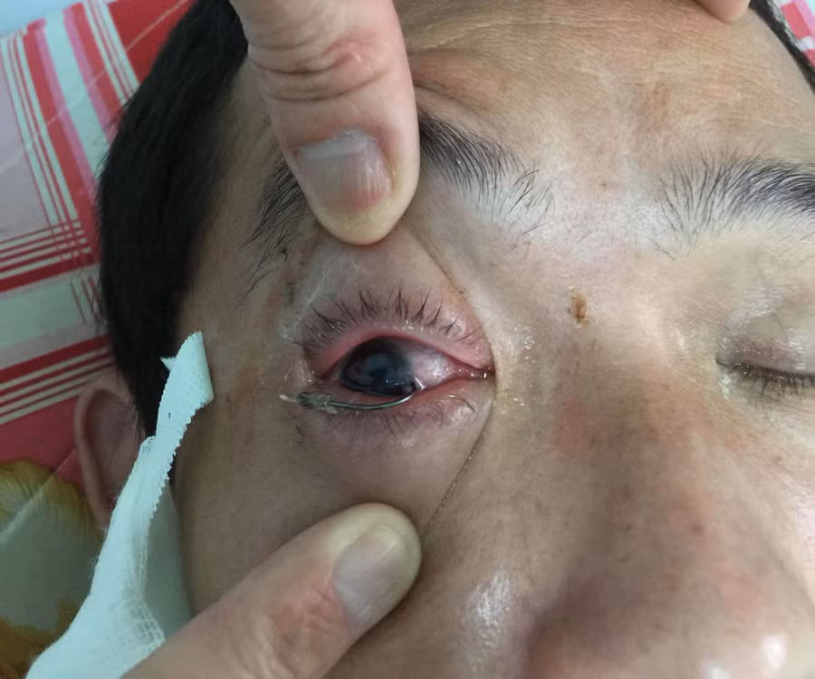  Bác sĩ bệnh viện Quân y 211 phẫu thuật thành công trường hợp lưỡi câu móc vào mắt. Ảnh: Chí Hào