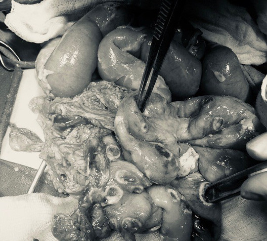  Đoạn ruột của bé trai dài 30 cm nhưng có tới 50 lỗ thủng do ấu trùng giun 