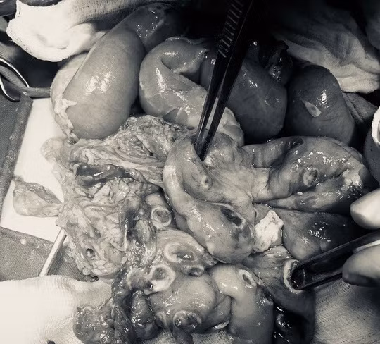  Đoạn ruột của bé trai dài 30 cm nhưng có tới 50 lỗ thủng do ấu trùng giun 