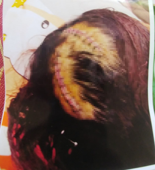 Thương tích do Hải dùng cuốc gây ra trên đầu chị Tâm Thương tích do Hải dùng cuốc gây ra trên đầu chị Tâm