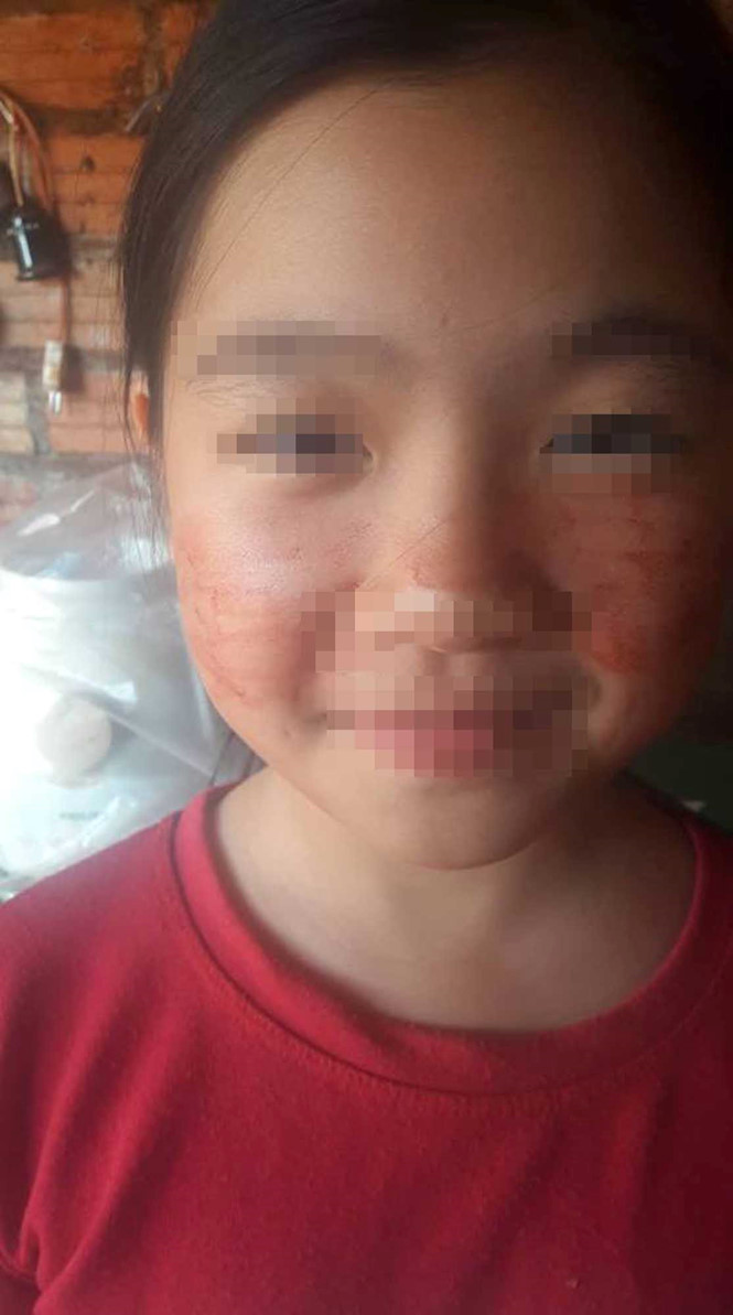 Bé N. bị ra mồ hôi máu trên mặt Bé N. bị ra mồ hôi máu trên mặt