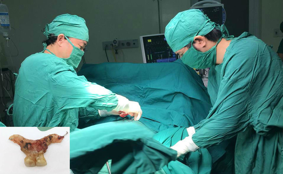 Bác sĩ phẫu thuật lấy hàm rang giả ra ngoài