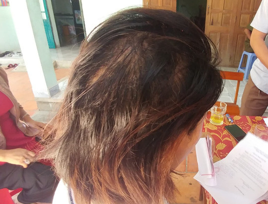 Tóc đã mọc lên trên vết thương cũ, nhưng chị Tâm vẫn chưa khỏi bàng hoàng khi kể lại vụ việc Tóc đã mọc lên trên vết thương cũ, nhưng chị Tâm vẫn chưa khỏi bàng hoàng khi kể lại vụ việc