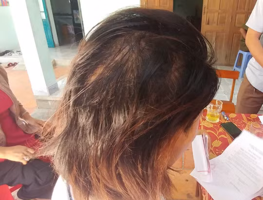 Tóc đã mọc lên trên vết thương cũ, nhưng chị Tâm vẫn chưa khỏi bàng hoàng khi kể lại vụ việc