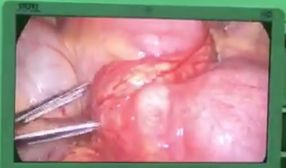 Hình ảnh phẫu thuật nội soi gắp dị vật  Hình ảnh phẫu thuật nội soi gắp dị vật
