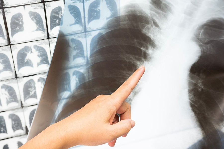 Bệnh tiểu đường mới khởi phát cũng có thể là dấu hiệu của ung thư tuyến tụy giai đoạn mới chớm. ẢNH SHUTTERSTOCK