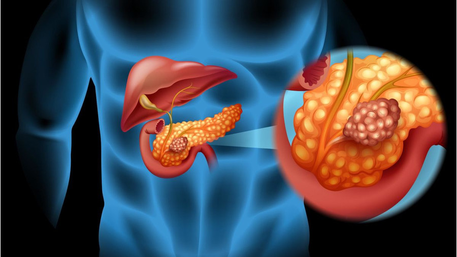 Hầu như tất cả những người mắc ung thư tuyến tụy đều không thể cứu được. Tỷ lệ sống sót sau 5 năm chỉ khoảng 7%. Ảnh: SHUTTERSTOCK